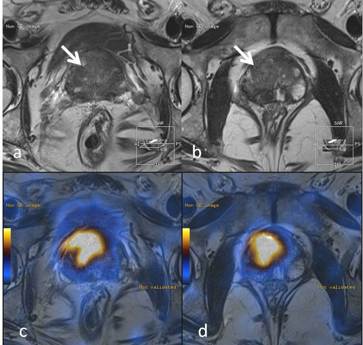 Correlation of apparent diffusion coefficient value on diffusion-weighted imaging and SUV values on PSMA PETCT in patients with biopsy-proven prostate cancer