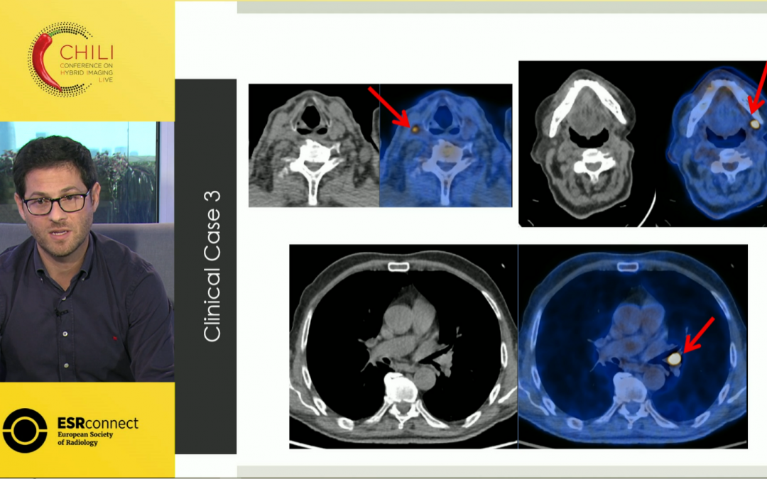 18F-FDG PET/CT in Oncology with Clinical Case Review