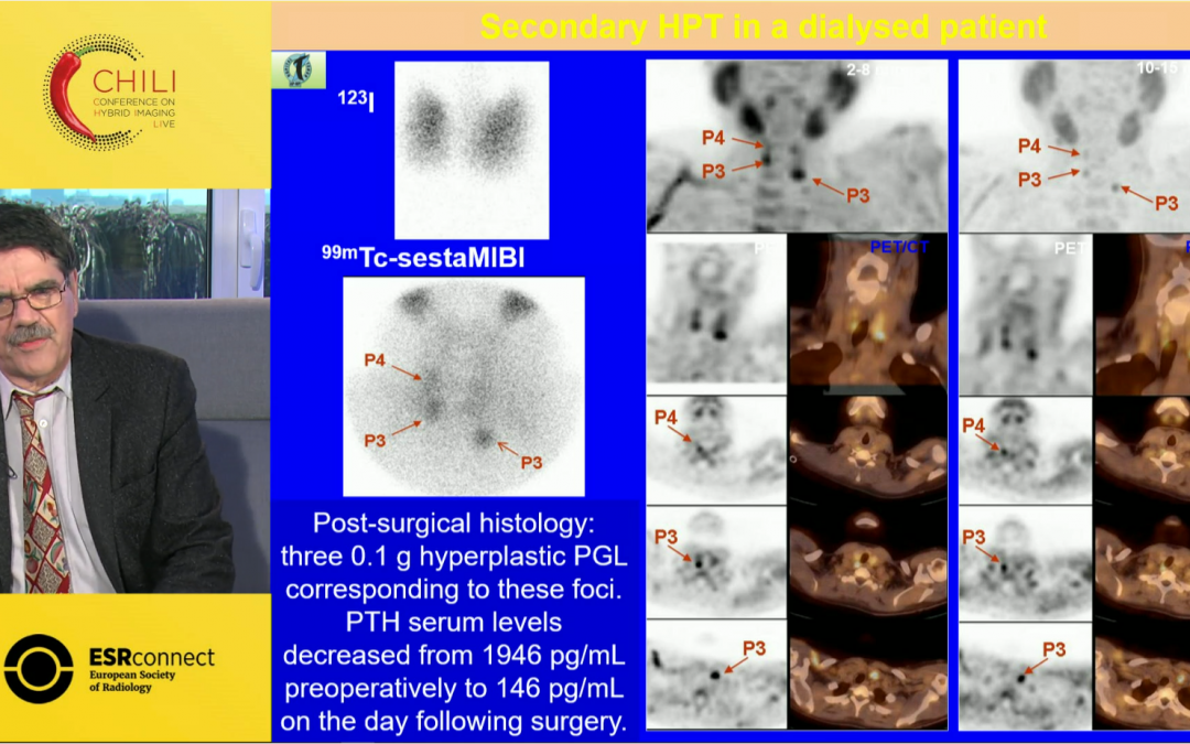 PET/CT in imaging Inflammation, Infection and Benign Tumours