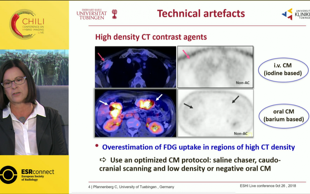 18F-FDG PET/CT in oncology: Pitfalls with clinical case review
