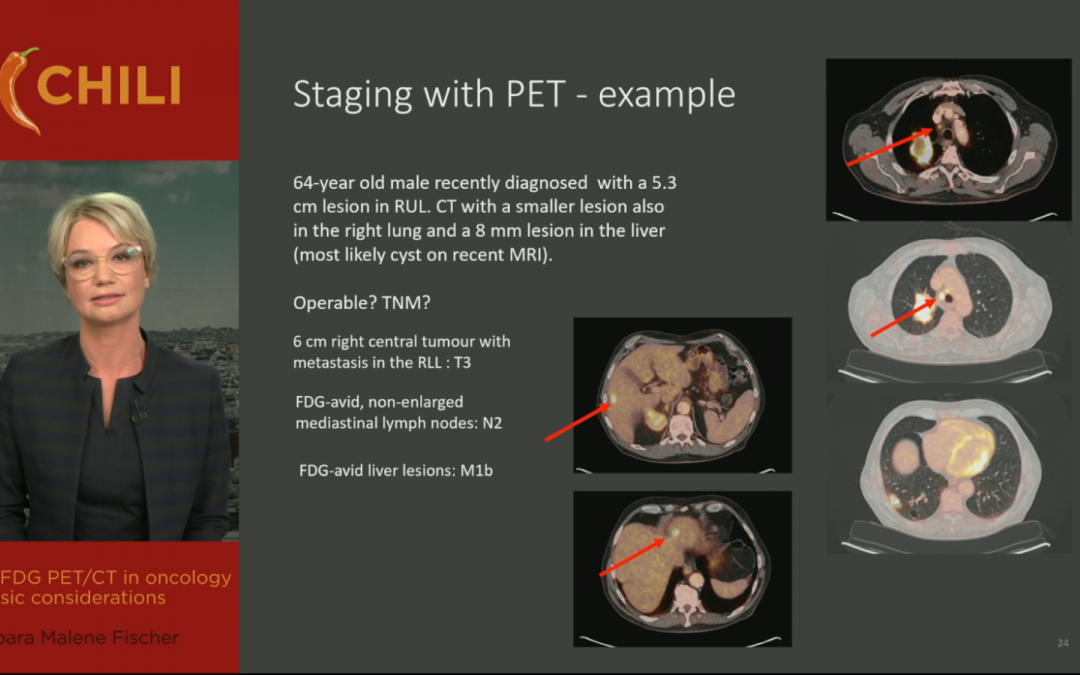 18F-FDG PET/CT in oncology – basic considerations