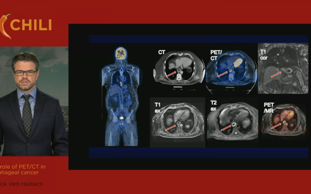 The role of PET/CT in esophageal cancer