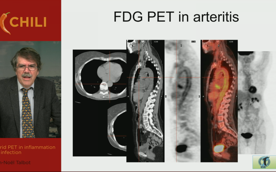 Hybrid PET in inflammation and infection