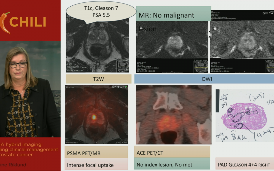PSMA hybrid imaging: guiding clinical management in prostate cancer