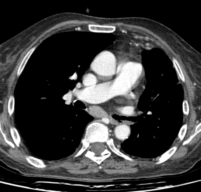 CT with contrast enhancement